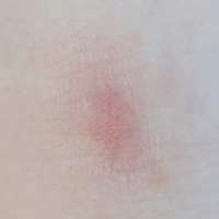 子どもの水いぼが潰れた、他の場所に感染する？