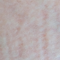 かゆみのない湿疹がどんどん増えていますがどうしたらいいですか？