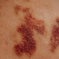 産後の唇の荒れと水泡、ヘルペスと口唇炎どちらでしょうか？