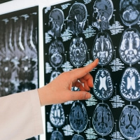 首下がり症候群はガランタミンの副作用でしょうか？
